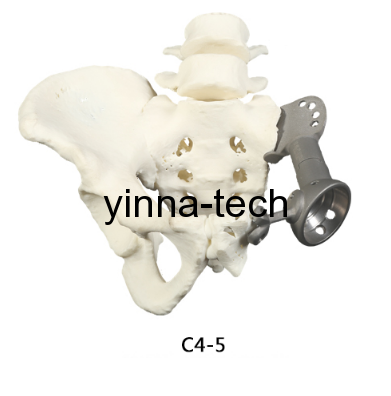 3D Printing and Medical Treatment-Surgical Metal Implants